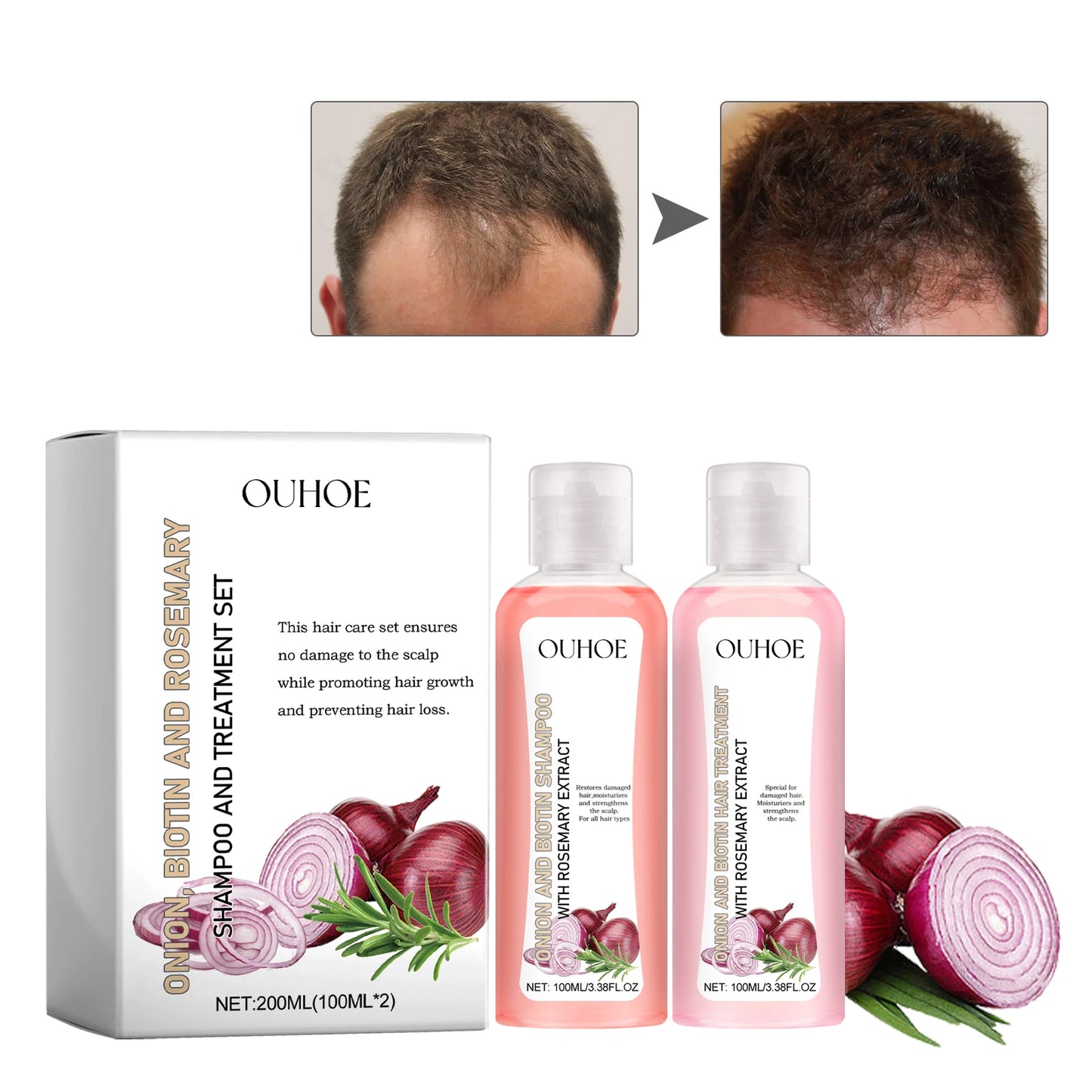 OUHOE Onion Biotin Rosemary Shampoo Set Nourishes Hair Roots Scalp Dense Hair Shiny Strengthen Promote Hair Growth Shampoo Set